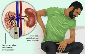 A man with Kidney Stones bending in pain and a diagram of how a kidney stone passes.